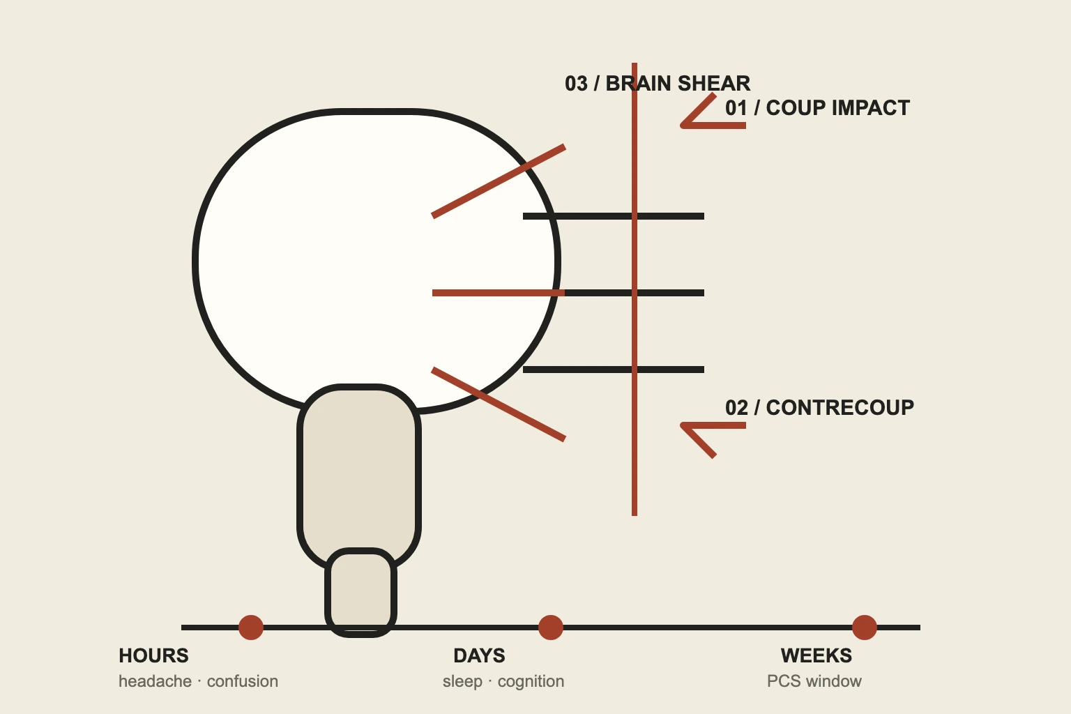 Geometric side-view concussion case plate with impact callouts and symptom timeline